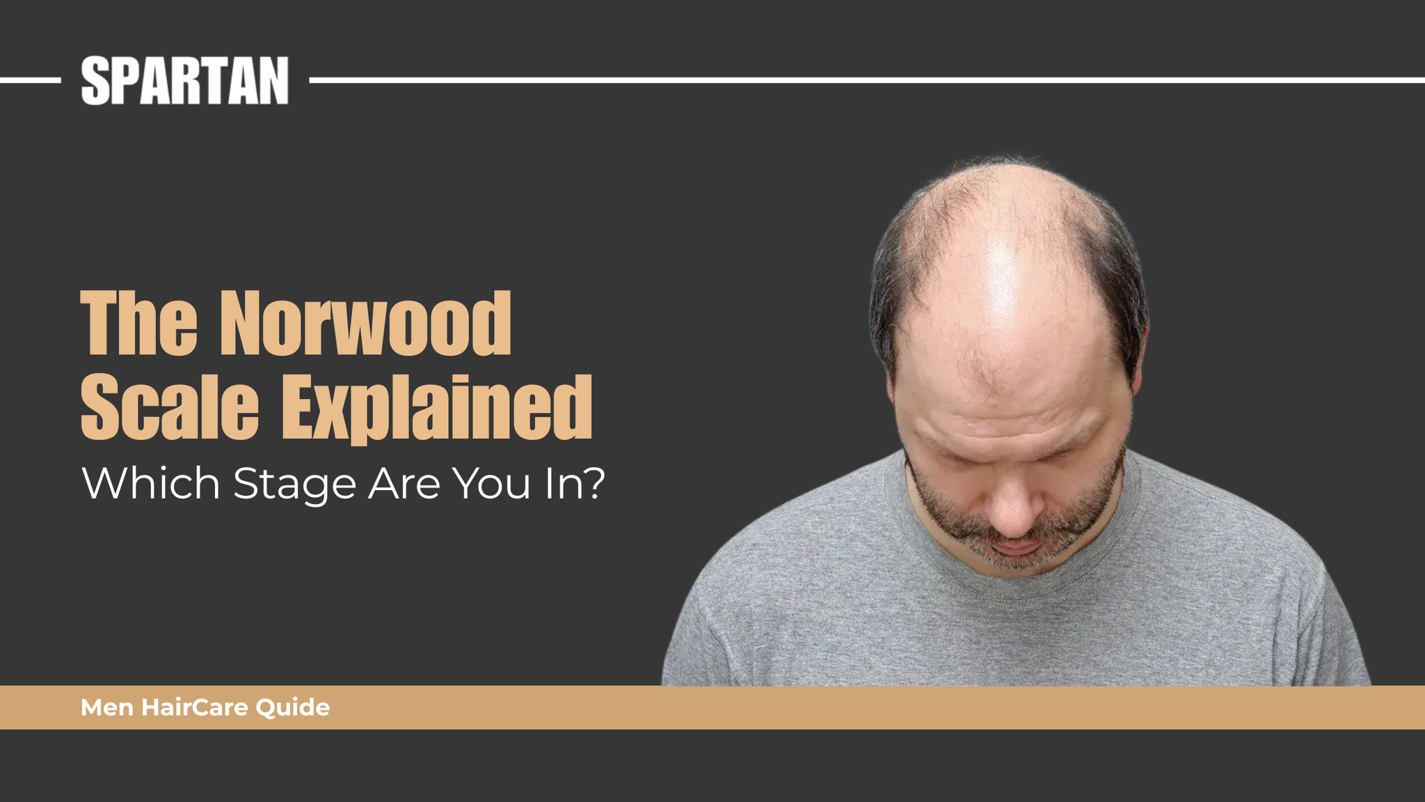 The Norwood Scale Explained: Which Stage Are You and What Can You Do About It?