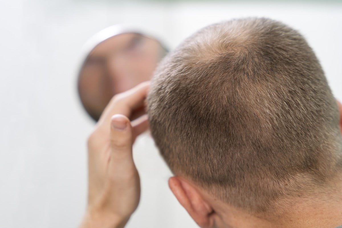 Does Wellbutrin Cause Hair Loss or Help?