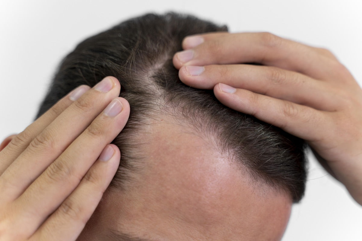 Does Minoxidil Cause Hair Loss or Help?