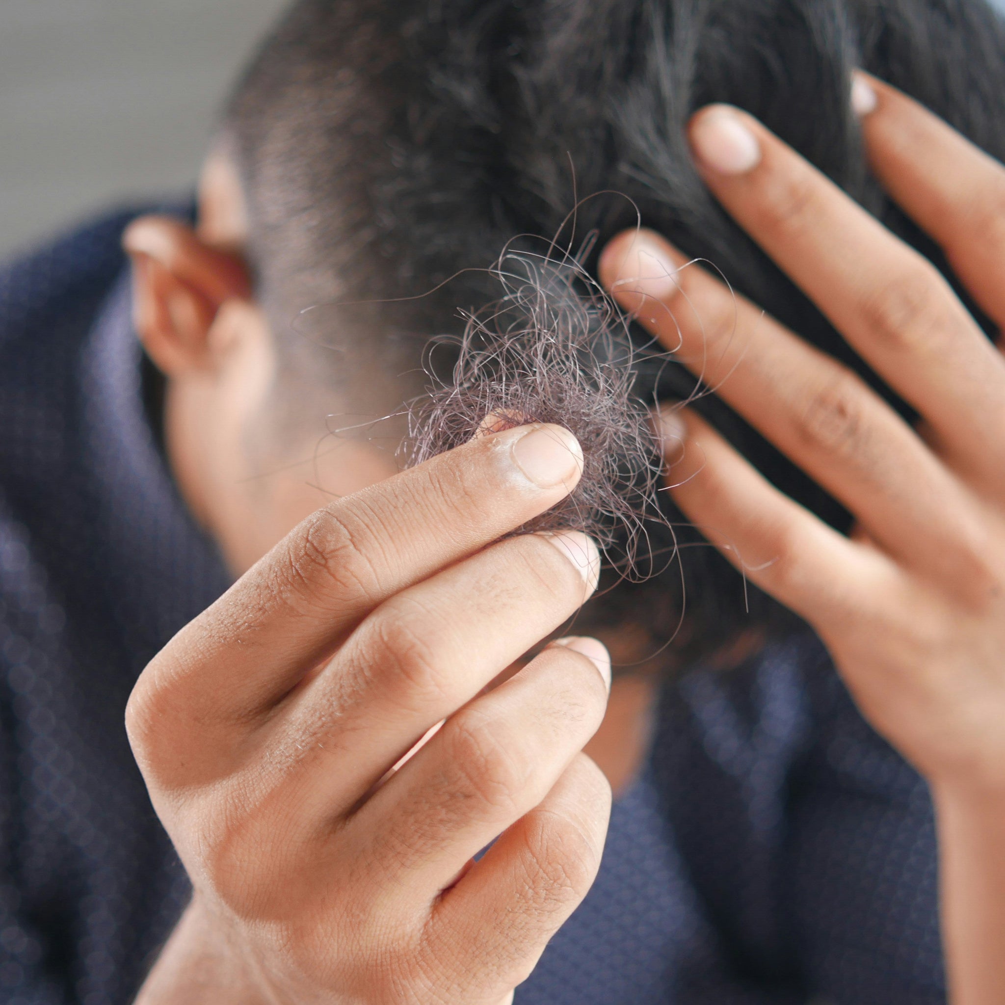 What Causes Hair Loss in Men?