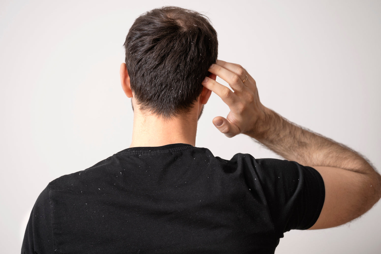 Does Dandruff Cause Hair Loss?