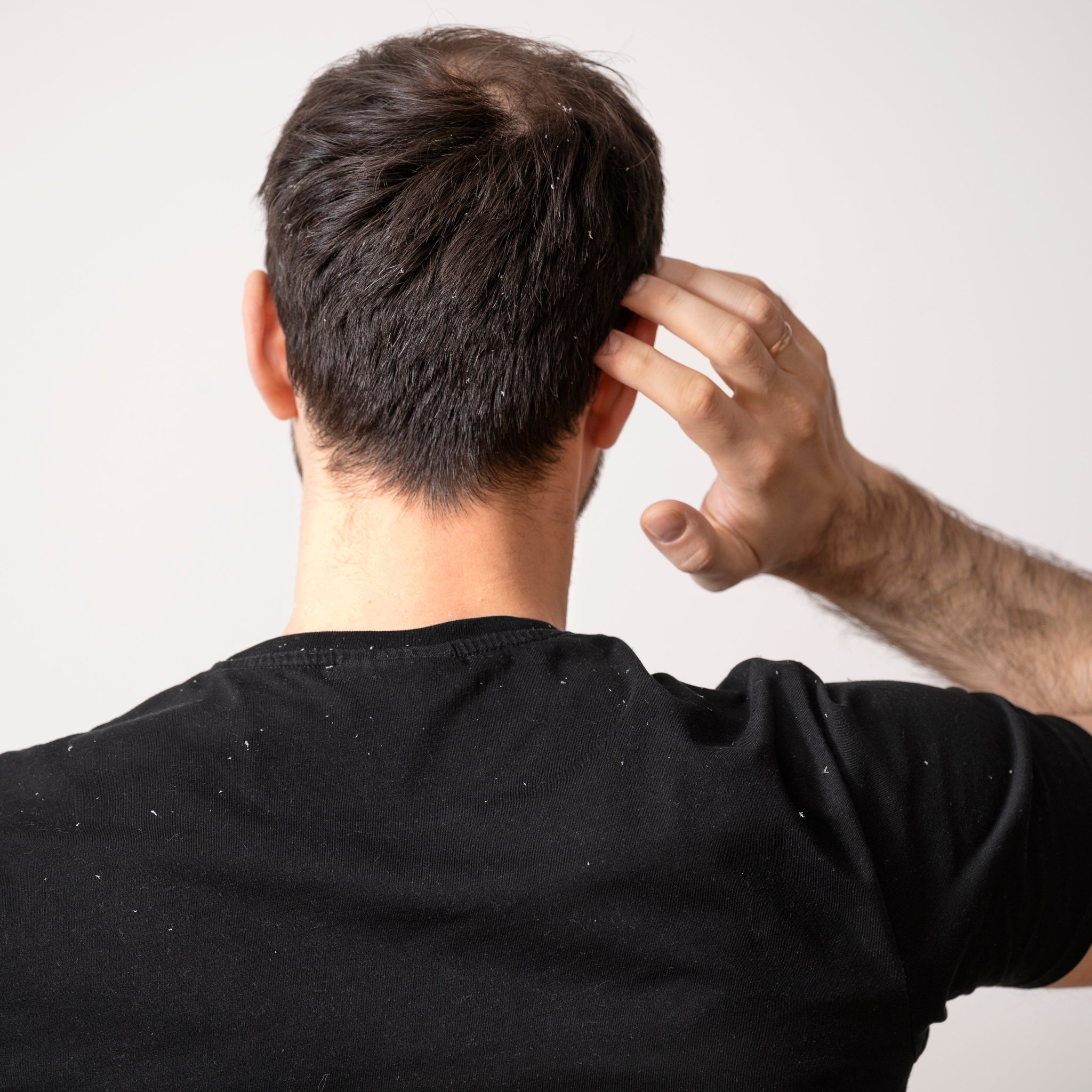 Does Dandruff Cause Hair Loss?