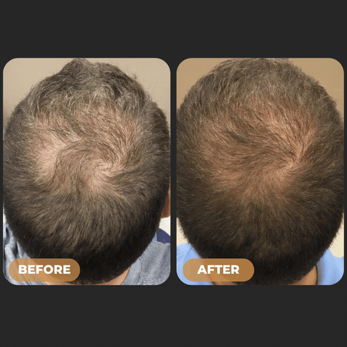 SPARTAN™ | Shampoo Bar for Men Hair Loss | Root Activator
