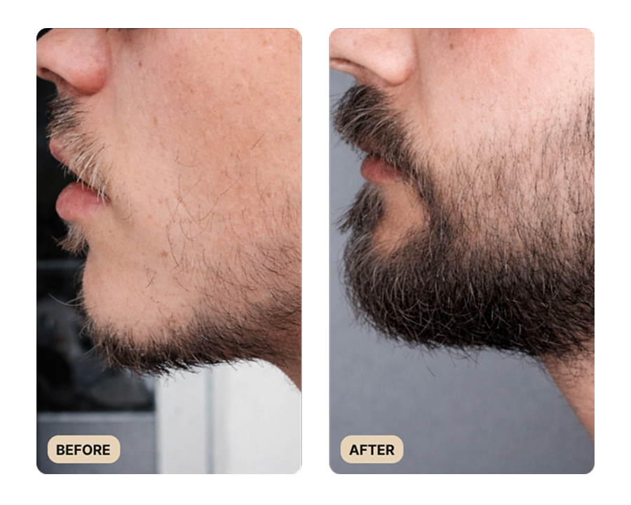 Beard Growth Kit (TEST)