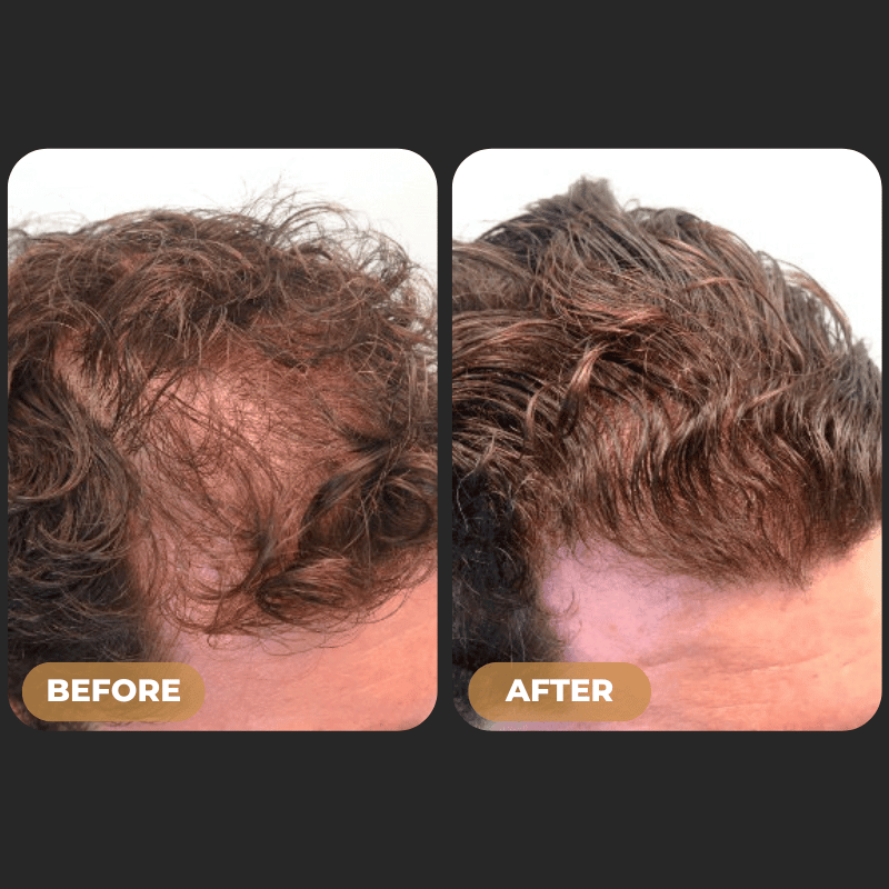 SPARTAN™ Root Activator Shampoo - Increased Hair Growth with Just 4 Washes a Week*