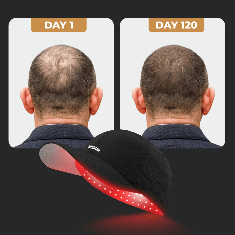 SPARTAN™ Red Light Cap for Hair Growth | 10 Weeks Results